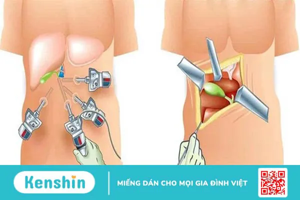 Các nguyên nhân gây tiêu chảy kéo dài bạn cần biết