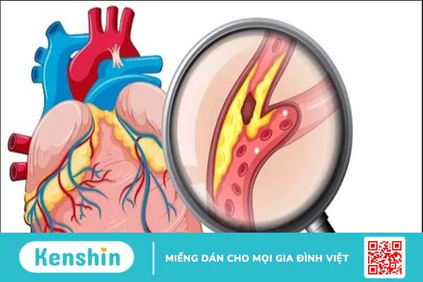 Các phương pháp điều trị bệnh mạch vành hiệu quả