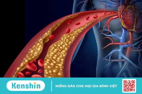 Các phương pháp điều trị bệnh mạch vành hiệu quả