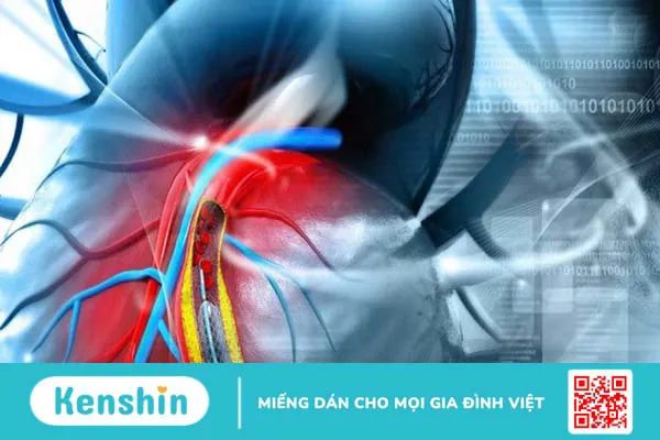 Các phương pháp điều trị bệnh mạch vành hiệu quả