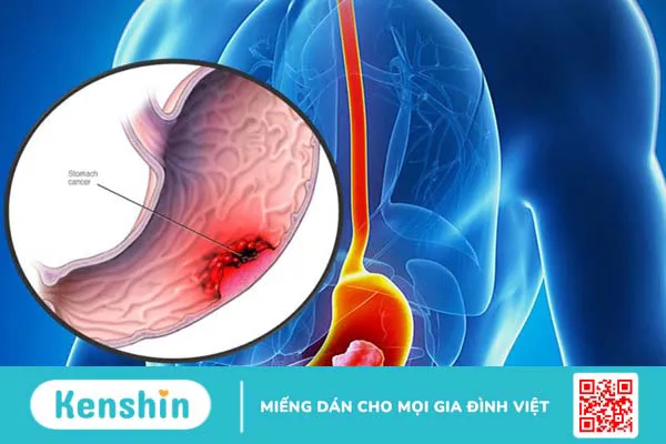 Các phương pháp điều trị ung thư dạ dày tiên tiến