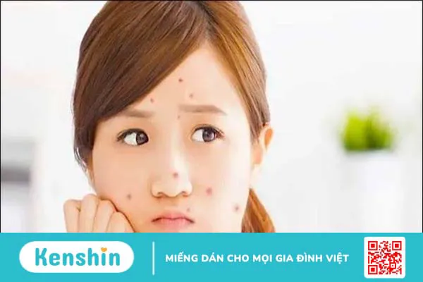 Cách chăm sóc da tuổi dậy thì đúng cách giúp da khỏe, ngăn ngừa mụn