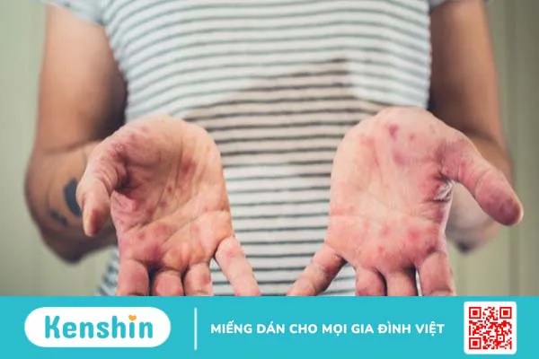 Cách chăm sóc trẻ bị tay chân miệng tại nhà hiệu quả ba mẹ nên biết