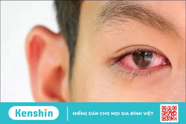 Cách chữa an toàn và nhanh chóng cho bà bầu bị đau mắt đỏ