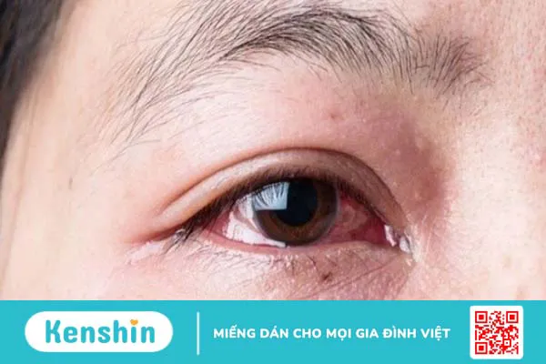 Cách chữa an toàn và nhanh chóng cho bà bầu bị đau mắt đỏ