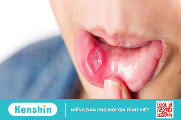 Cách chữa viêm loét miệng hiệu quả tại nhà