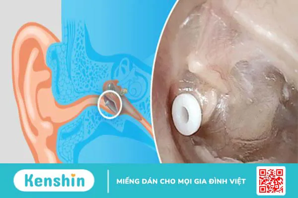 Cách chữa viêm tai giữa cho trẻ mà bố mẹ cần lưu ý