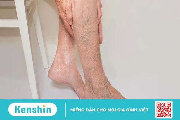 Cách điều trị giãn tĩnh mạch chân tại nhà