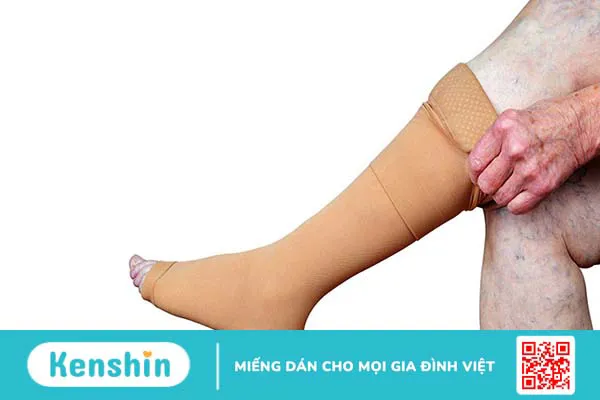 Cách điều trị giãn tĩnh mạch chân tại nhà