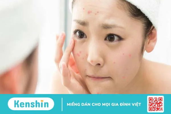 Cách dùng kem trị mụn đúng cách, hiệu quả cho da và lưu ý khi dùng