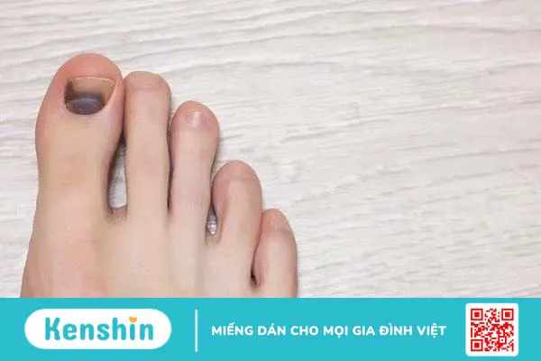 Cách dưỡng móng chân bị hư tại nhà giúp móng nhanh mọc lại