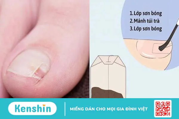 Cách dưỡng móng chân bị hư tại nhà giúp móng nhanh mọc lại