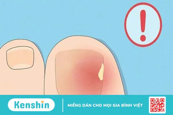 Cách dưỡng móng chân bị hư tại nhà giúp móng nhanh mọc lại