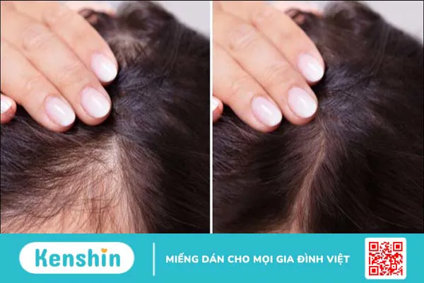 Cách gội đầu bằng bồ kết tại nhà giúp trị rụng tóc, nhanh dài