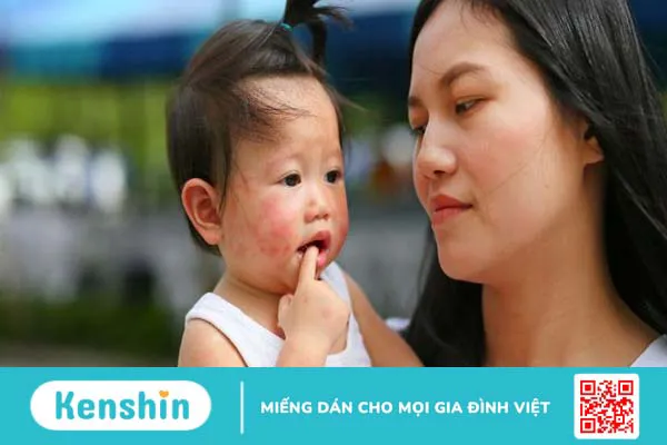 Cách hạn chế triệu chứng và phòng tránh dị ứng thời tiết hiệu quả