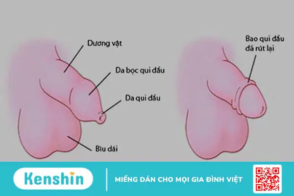 Cách nhận biết hẹp bao quy đầu ở trẻ em chính xác