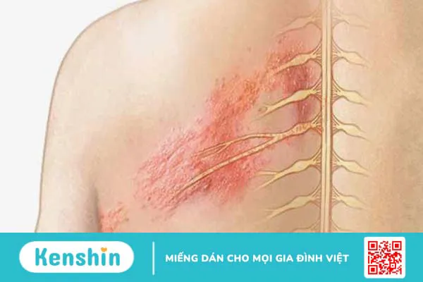 Cách phân biệt bệnh zona thần kinh và giời leo