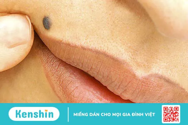 Cách phân biệt tàn nhang và nốt ruồi