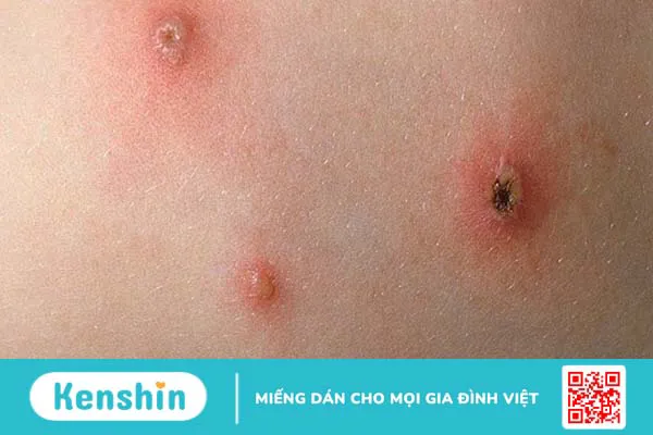 Cách phòng bệnh thường gặp vào mùa tựu trường và những lưu ý cho trẻ