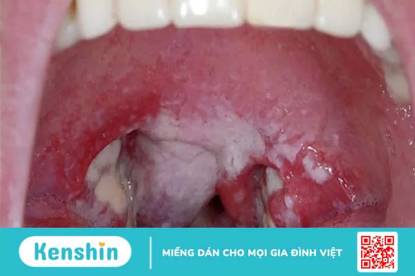 Cách phòng chống bệnh bạch hầu và biến chứng bạn nên biết