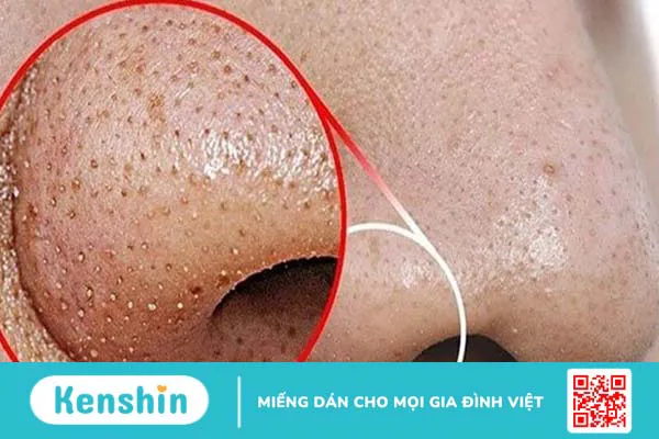 Cách rửa mặt đúng cách cho da mụn giúp nhanh hồi phục và giảm thâm