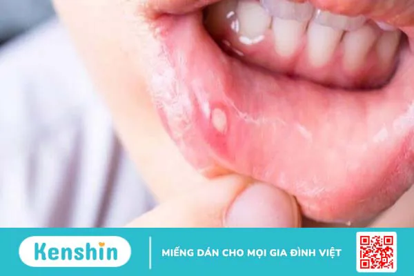 Cách súc miệng bằng nước muối sinh lý đúng, giúp bảo vệ răng miệng