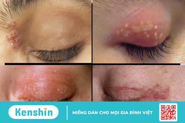 Cách trị giời leo tại nhà an toàn giúp bạn nhanh khỏi bệnh