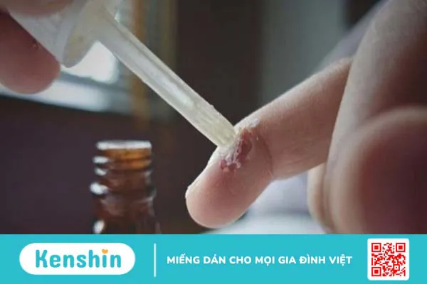 Cách trị mụn cóc ở chân (mụn cóc Plantar) an toàn, hiệu quả