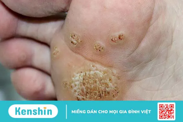 Cách trị mụn cóc ở chân (mụn cóc Plantar) an toàn, hiệu quả