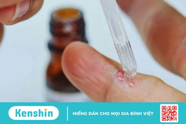 Cách trị mụn cóc tại nhà, bệnh viện hiệu quả và tránh lây lan