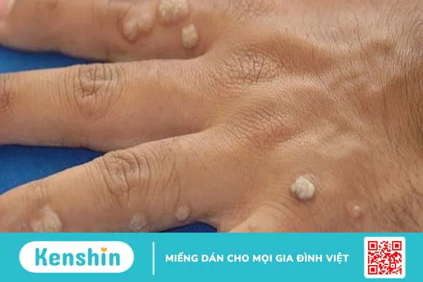 Cách trị mụn cóc tại nhà, bệnh viện hiệu quả và tránh lây lan