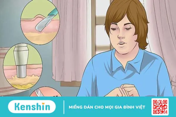 Cách trị mụn cóc tại nhà, bệnh viện hiệu quả và tránh lây lan