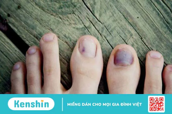 Cách xử lý móng chân bị hư an toàn, hiệu quả, tránh nhiễm trùng