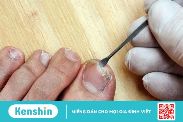 Cách xử lý móng chân bị hư an toàn, hiệu quả, tránh nhiễm trùng