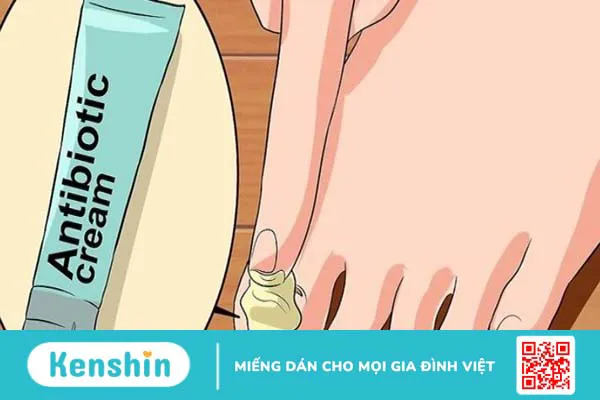 Cách xử lý móng chân bị hư an toàn, hiệu quả, tránh nhiễm trùng