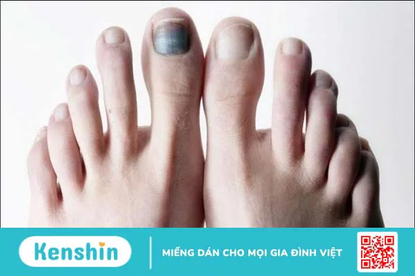 Cách xử lý móng chân bị hư an toàn, hiệu quả, tránh nhiễm trùng