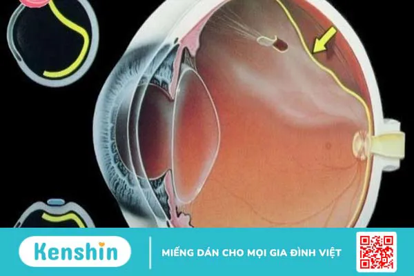 Cận thị mấy độ là nặng? Các biến chứng của cận thị nặng