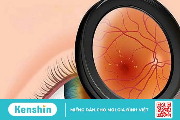 Cận thị mấy độ là nặng? Các biến chứng của cận thị nặng