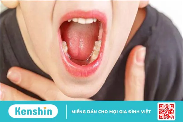 Cảnh báo 11 dấu hiệu ung thư lưỡi bạn không nên bỏ qua