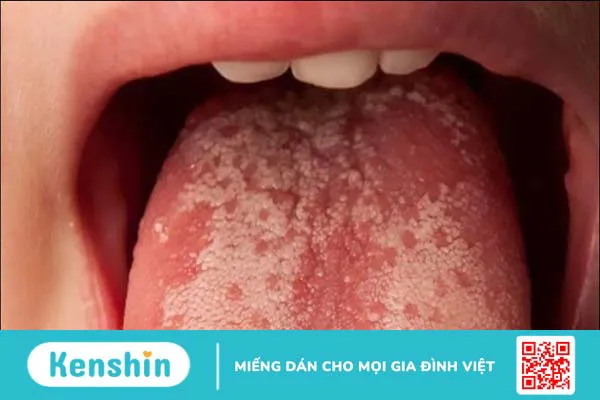 Cảnh báo 11 dấu hiệu ung thư lưỡi bạn không nên bỏ qua