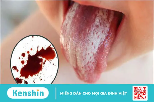 Cảnh báo 11 dấu hiệu ung thư lưỡi bạn không nên bỏ qua