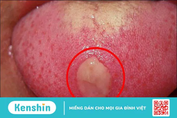 Cảnh báo 11 dấu hiệu ung thư lưỡi bạn không nên bỏ qua