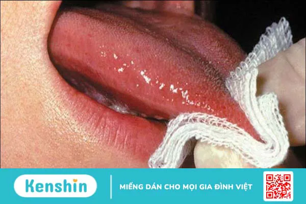 Cảnh báo 11 dấu hiệu ung thư lưỡi bạn không nên bỏ qua