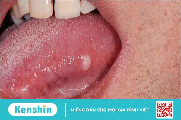 Cảnh báo 11 dấu hiệu ung thư lưỡi bạn không nên bỏ qua