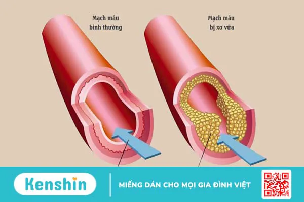 Cảnh báo 13 nguyên nhân xuất huyết não bạn không nên chủ quan