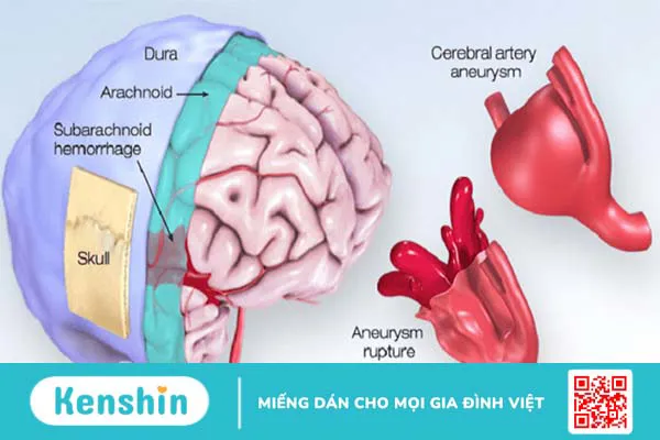 Cảnh báo 13 nguyên nhân xuất huyết não bạn không nên chủ quan