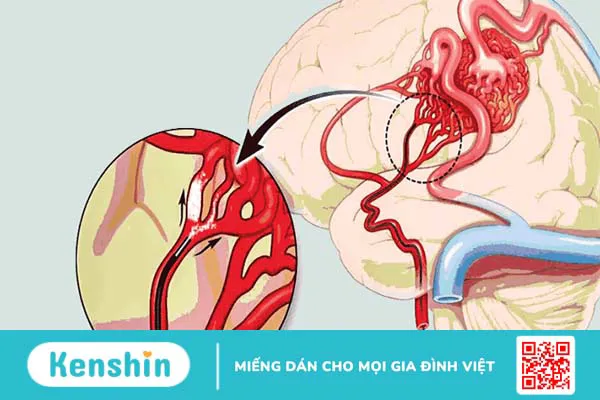 Cảnh báo 13 nguyên nhân xuất huyết não bạn không nên chủ quan