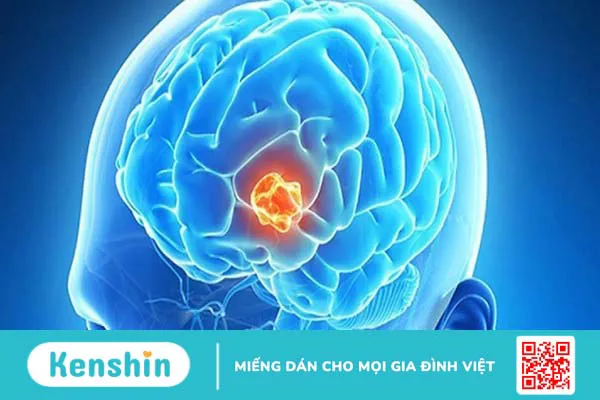 Cảnh báo 13 nguyên nhân xuất huyết não bạn không nên chủ quan