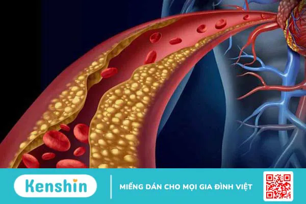 Cảnh báo 3 nguyên nhân viêm tụy cấp điển hình không thể chủ quan