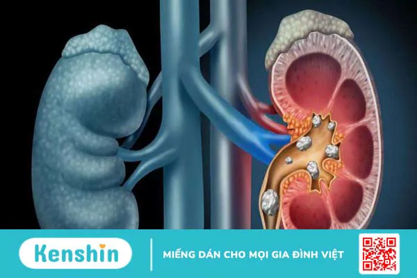 Cảnh báo 5 nguyên nhân suy thận có thể bạn chưa biết